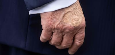 Seltsamer Fleck an Trumps Hand sorgt für Spekulationen – Weißes Haus veröffentlicht Arztbefund