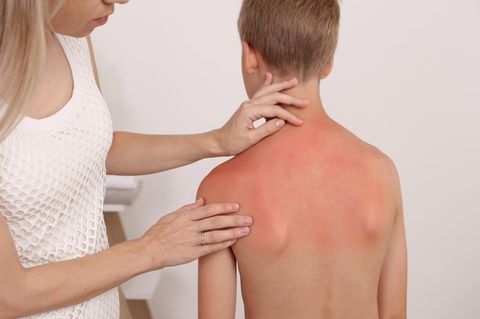 Sonnenallergie bei Kindern rechtzeitig behandeln – darauf müssen Sie achten