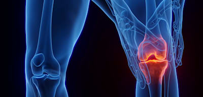 Bei Knie-Arthrose kann ein anderer Gang die Schmerzen spürbar lindern