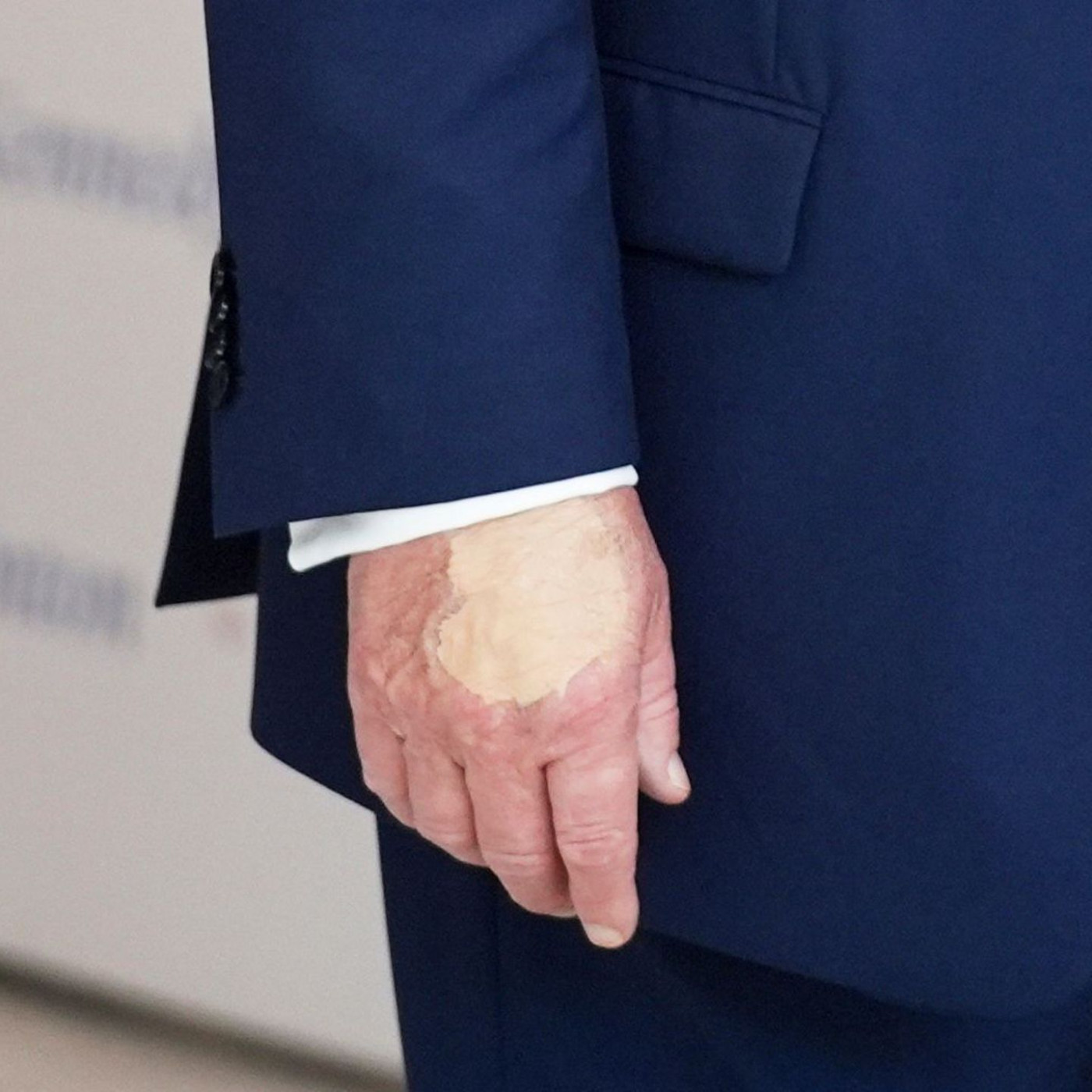 Flecken an Trumps Hand – das steckt laut Weißem Haus dahinter