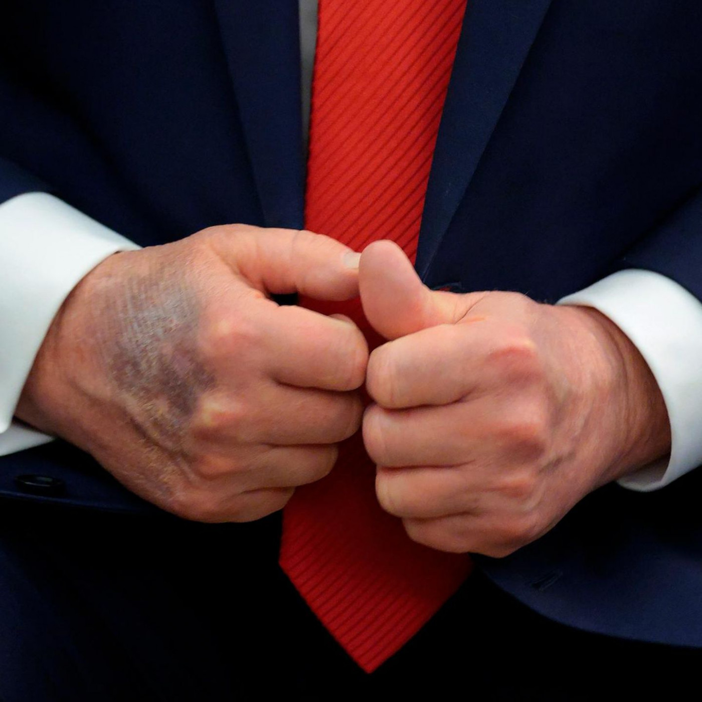Trump erneut mit Bluterguss an der Hand fotografiert
