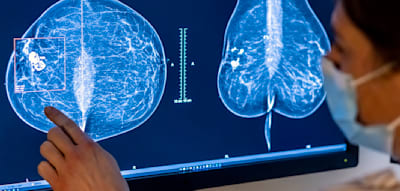 Über 2000 Frauen von Mammografie-Fehler betroffen – für einige kommt die Warnung zu spät