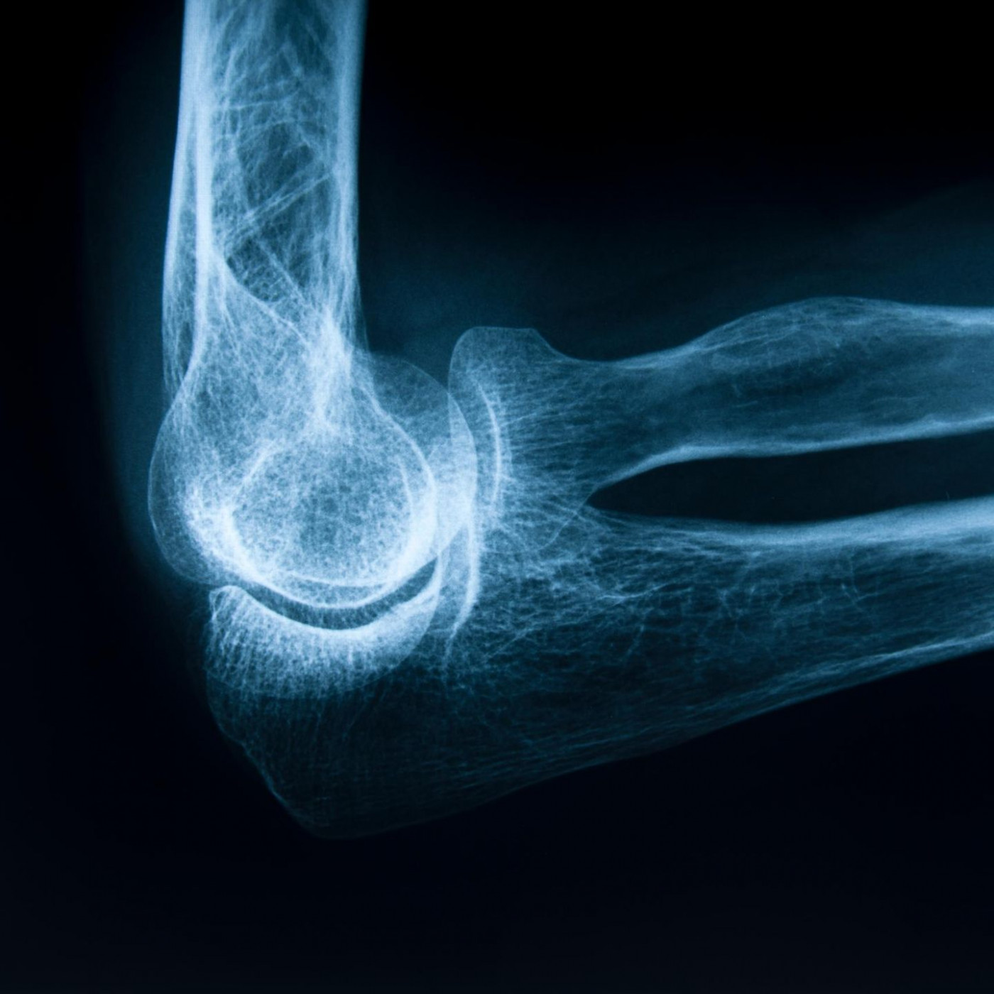Osteoporose: Die neue Wahrheit über unsere Knochen