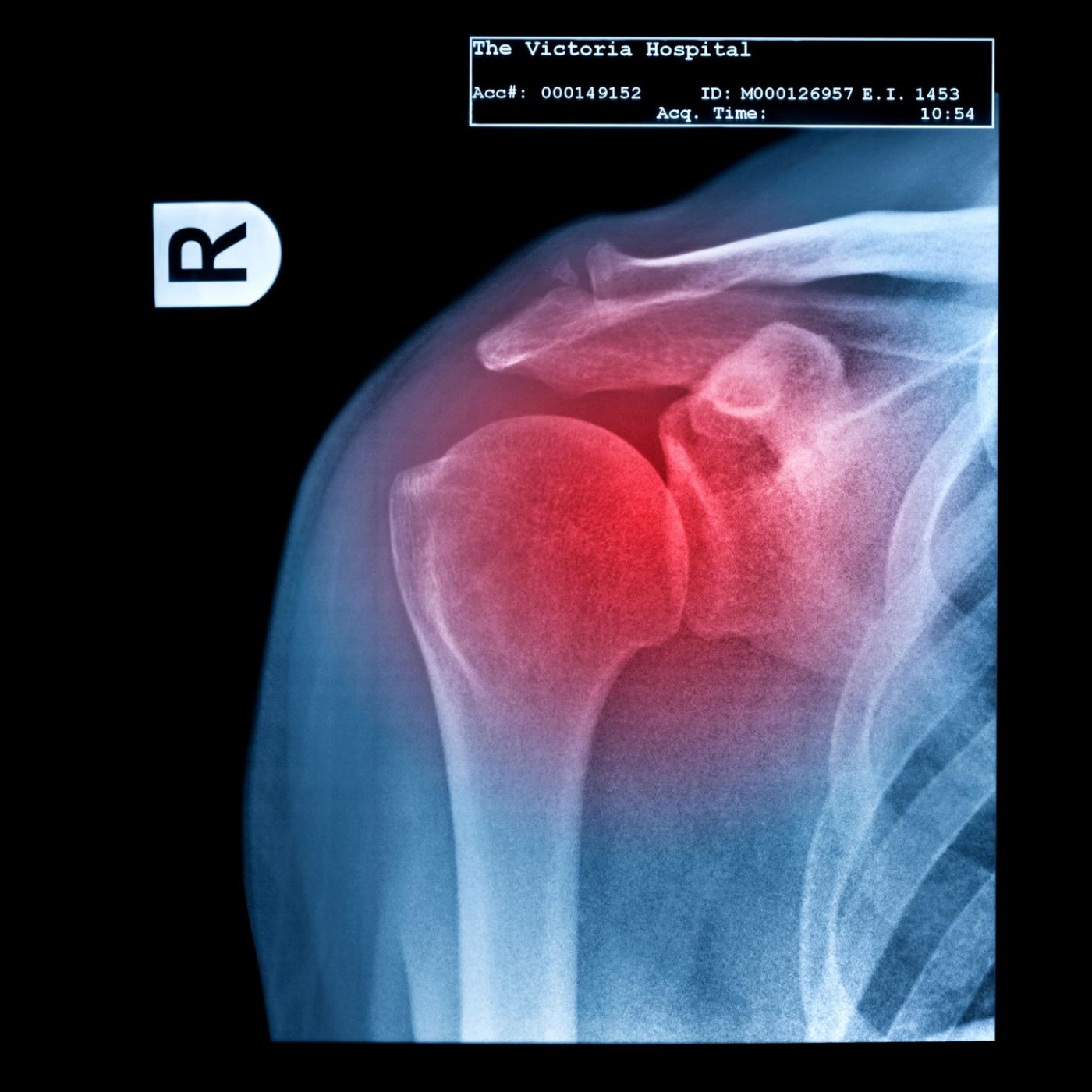 Warum es bei Schulterschmerz so wichtig ist, die genaue Ursache zu kennen