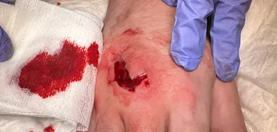 „Unser Trainer hat meine Haut aufgehoben und in eine Plastiktüte gesteckt“