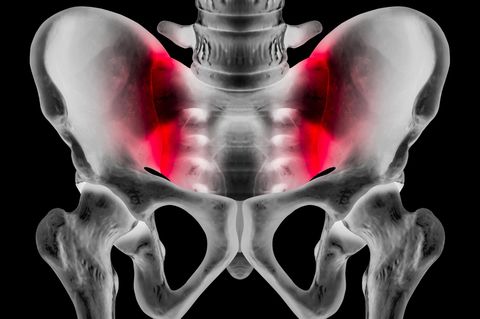 Schmerzen im Iliosakralgelenk – was tun?