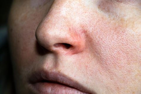 Rosacea-Creme gegen Hautrötungen: Diese Produkte sollen die Symptome lindern