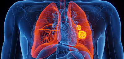 „Wenn wir das berücksichtigen, entdecken wir gut 20 Prozent mehr Fälle“