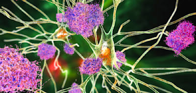 Neue Tablette bremst Alzheimer im Frühstadium – doch Experten zweifeln