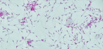 Samenspender mit Krebs-beg&uuml;nstigender Genmutation zeugte fast 200 Kinder