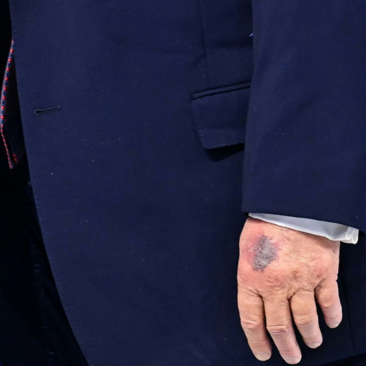 Wei&szlig;es Haus: Bluterguss an Trumps Hand hat mit "Friedensrat" zu tun