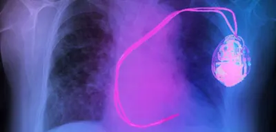 Der kleinste Herzschrittmacher der Welt hilft einem Kind &ndash; und einem Hund