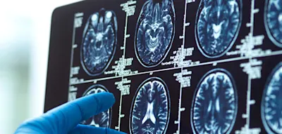 Neuer Test sagt Alzheimer mit erstaunlicher Genauigkeit voraus