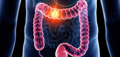 Statt Darmspiegelung &ndash; auch einfacher Stuhltest reduziert Risiko signifikant