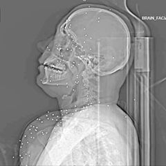 R&ouml;ntgenbilder entlarven brutales Vorgehen gegen Protestierende im Iran
