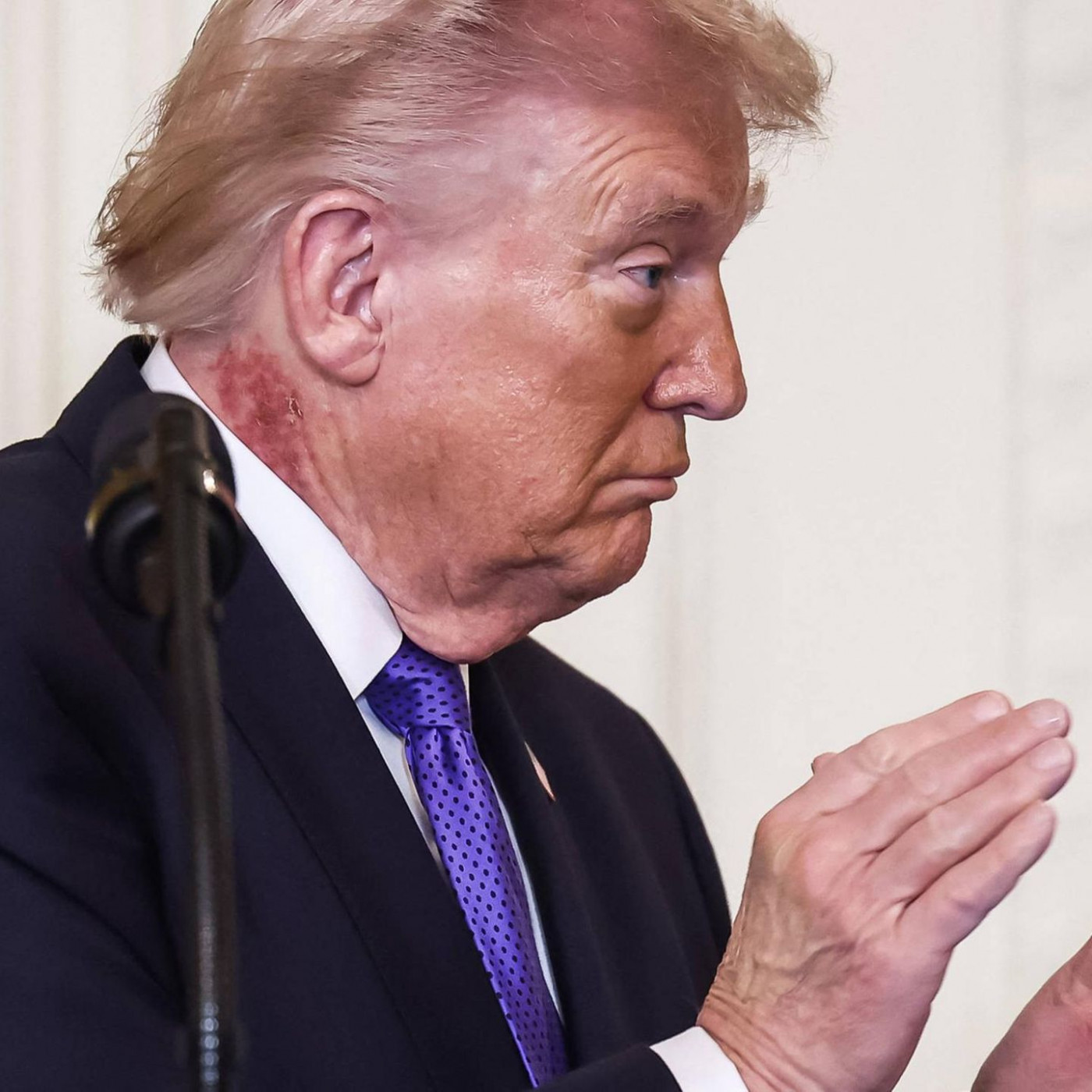 Fleck am Hals befeuert Spekulationen &uuml;ber Trumps Gesundheit