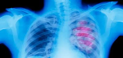 Forscher weisen Effekt von Grippe und Covid-19 auf Risiko f&uuml;r Lungentumore nach