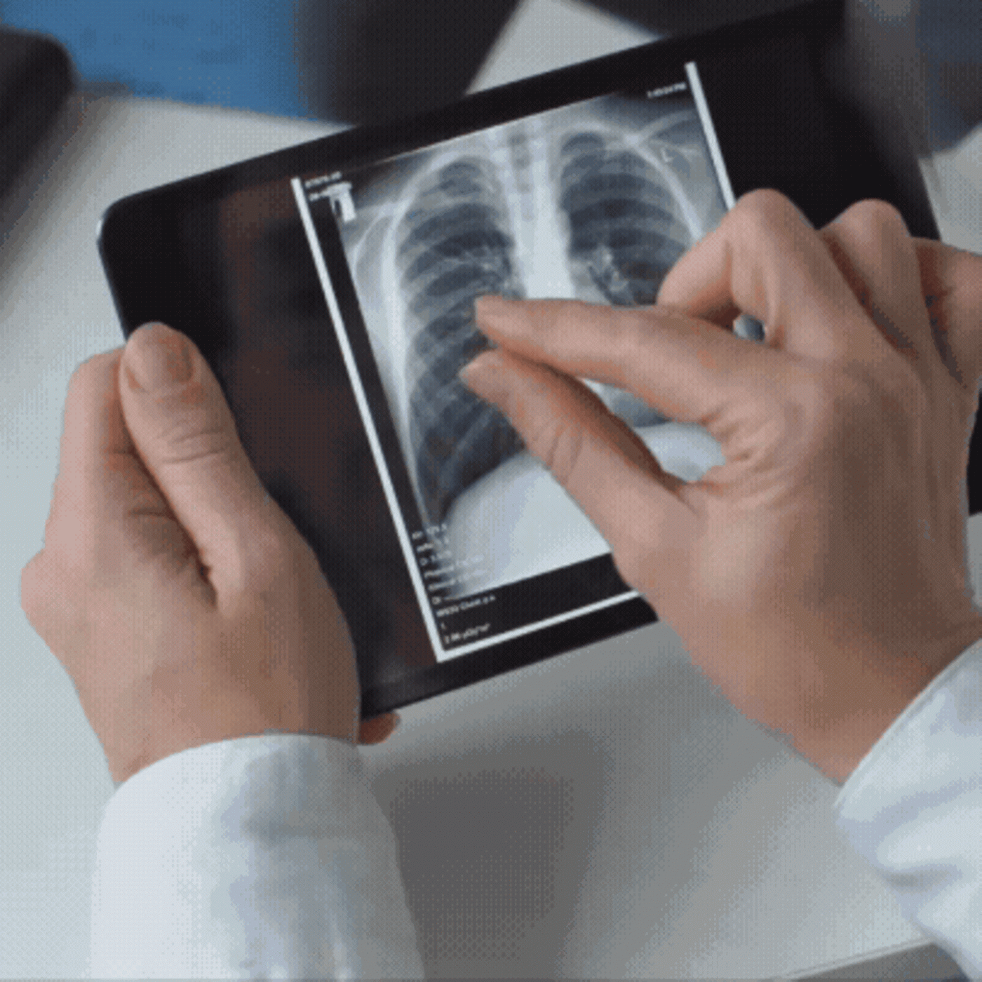 Was Raucher und Ex-Raucher &uuml;ber das neue Lungenkrebs-Screening wissen sollten