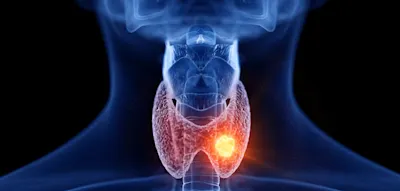 Schilddr&uuml;se &ndash; &bdquo;Das Problem der &Uuml;berdiagnose versch&auml;rft sich zunehmend&ldquo;