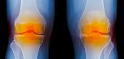 Knie-Arthrose verlangsamen &ndash; &bdquo;Die GLP-1-Analoga stellen eine therapeutische Goldgrube dar&ldquo;
