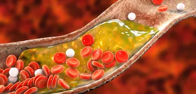 Wie Vitamin-D-Mangel das Sterberisiko bei Adipositas dramatisch beeinflusst