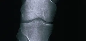 Risiko f&uuml;r Osteoporose &ndash; &bdquo;Ab einem Alter von etwa 30 Jahren geht es los&ldquo;